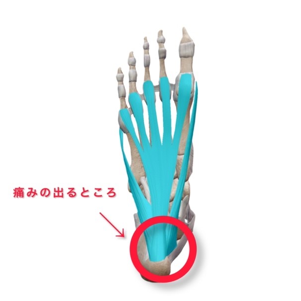 ランナー特有の足底筋膜炎はストレッチで予防!